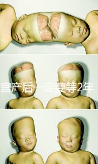 剖宮產后一定要等2年，才能試管嬰兒懷孕嗎？