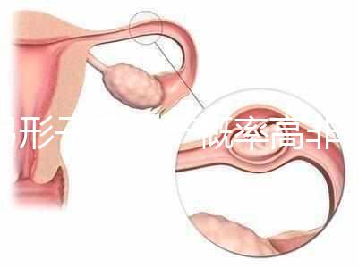 弓形子宮流產概率高非個例！罪魁禍首是這個原因