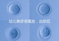 幼兒急疹很高發(fā)，出疹后的護(hù)理方法及注意事項(xiàng)提前知曉！