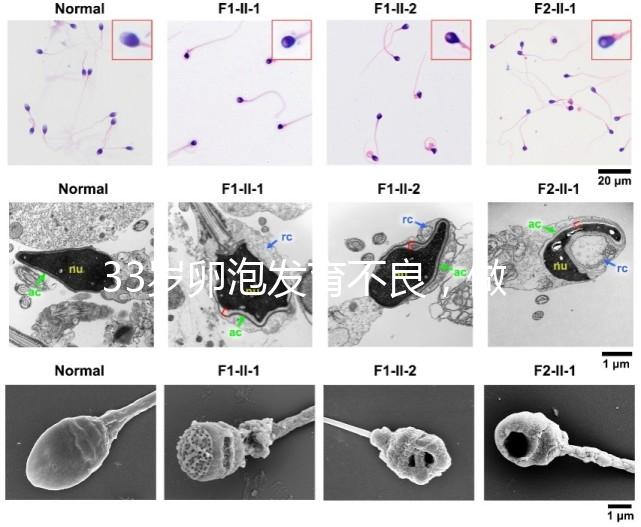 33歲卵泡發育不良，做試管黃體期促排方案失敗怎么辦？