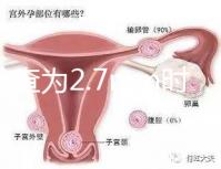 nt檢查為2.7mm時危險性莫亂猜,做完無創(chuàng)后才能確定